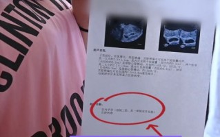 不孕女子喜获3胞胎同卵异卵同出现 医生：第一次见